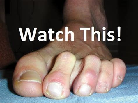 For this surgery, a doctor cuts ligaments and tendons to. Bunion & Hammer Toe Surgery Recovery Tips in 2 minutes ...