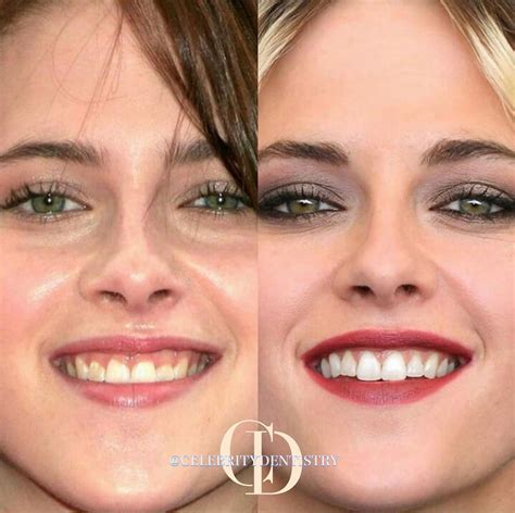 Kristen Stewarts Smile Makeover 🤩 Celebritydentistry
