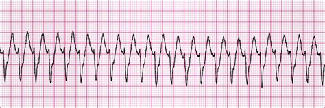 Vt (ventricular tachycardia) vs svt (supraventricular tachycardia) with aberrancy. Advanced Cardiac Life Support Course | Atlanta, Ga