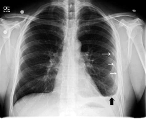 Detecting And Diagnosing Chest Trauma Through X Ray Radiographic