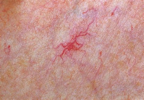 Spider Naevus On Skin Photograph By Dr Hcrobinsonscience Photo
