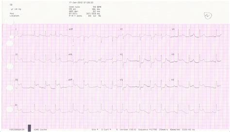 Electrocardiogram Showing Inferolateral Wall St‑elevation Myocardial