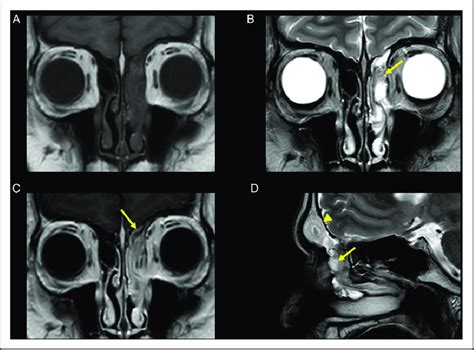 Images Of Inverted Papilloma On Mri A T Weighted Coronal Imaging