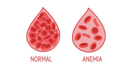 Anemia Morphological Classification • The Blood Project