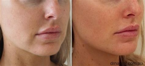 Before And After Dermal Filler To Marionettes Jawline Chin