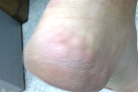Derm Dx White Lumps On The Heel When Standing Clinical Advisor