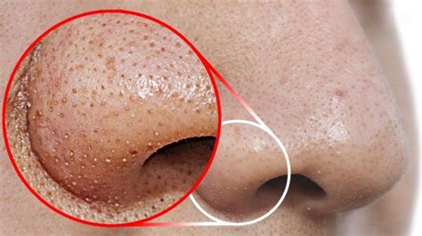 Blackheads Causes Symptoms Treatment And Home Remedies
