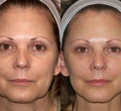 Botox For Your Lower Face And Neck