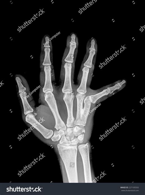 Film Xray Hand Ap Show Fracture Stock Photo 227195593 Shutterstock