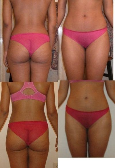Do you have any insights into my 4 months post lipo bulge? Can Smart Lipo Be Done in Same Areas Again? Doctor Answers ...
