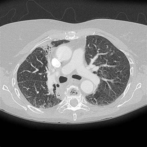 Post Radiotherapy Pulmonary Fibrosis Image