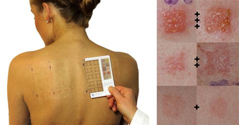 Patch Test Patch Test For Cosmetics Patch Test For Contact Dermatitis