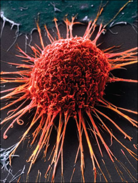 Bevacizumab In Cervical Cancer A Step Forward For Survival The Lancet