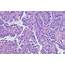 Esophageal Adenocarcinoma He Stain Stock Photo  Download Image Now