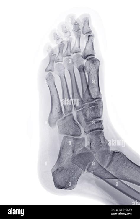 Foot X Ray Image Oblique View Isolated On White Background Stock Photo