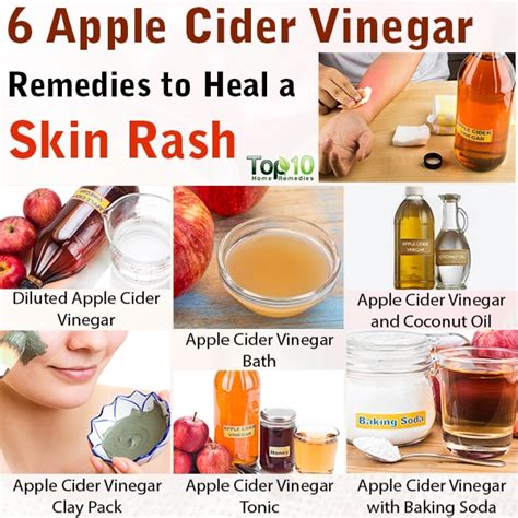 6 Apple Cider Vinegar Remedies To Heal A Skin Rash Top 10 Home Remedies
