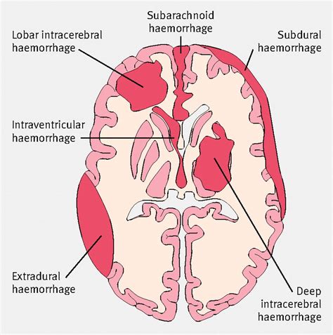 Types Of Brain Hemorrhages Subdural Hematoma Hemorrhage Nursing