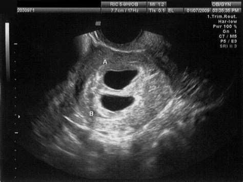 Transvaginal Ultrasound During Pregnancy