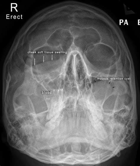 Facial Bone Radiography Wikiradiography