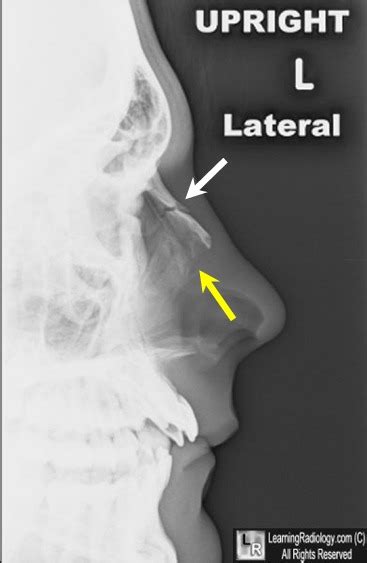 Learning Radiology nenäluun murtuma nenä Cercle Blog