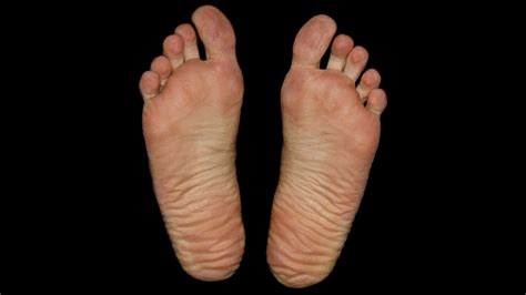 What Is A Ganglion Cyst Of The Foot And What Can You Do About It