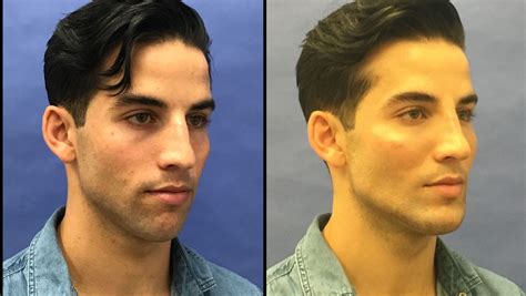 You will find several rhinoplasty photos (nose job) below demonstrating different results. 5 Reasons Why Male Rhinoplasty is Becoming so Popular in ...