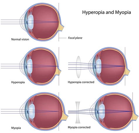Nearsighted Myopia Petrou Eye Care