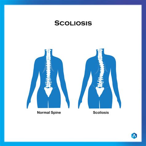 Scoliosis Dr Abbie Clinics