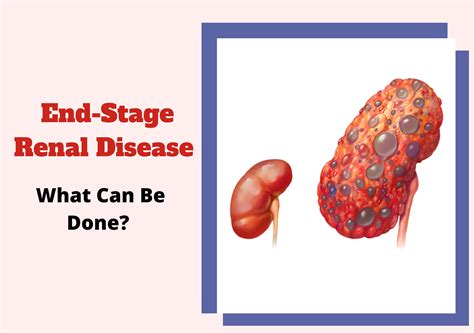 End Stage Renal Disease Kidney Disease What Can Be Done