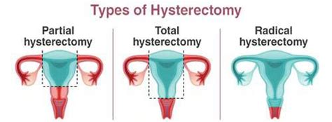 Sex After Hysterectomy Everything You Need To Know About