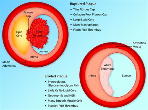 Reassessing The Mechanisms Of Acute Coronary Syndromes Circulation