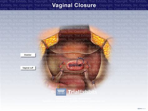 Vaginal Closure Trialexhibits Inc