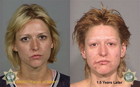 Horrifying Before And After Photos Of Meth Users Mother Jones