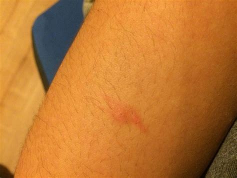 Weird Long Red Mark On Arm At Parasites Support Forum Alt Med Topic