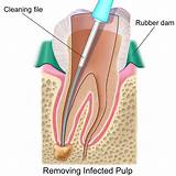 Photos of Root Canal Treatment Procedure Pictures