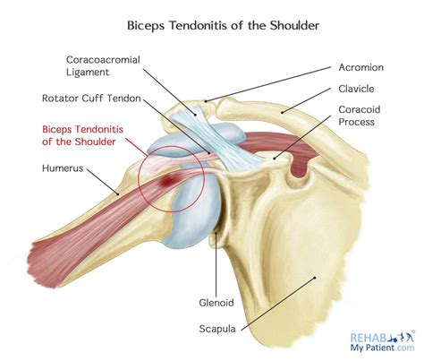 Biceps Tendonitis Of The Shoulder Rehab My Patient