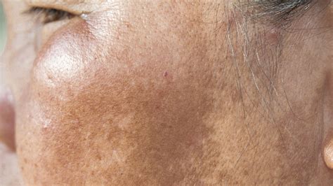 Melasma Dark Patches On Your Skin Suganda Skincare