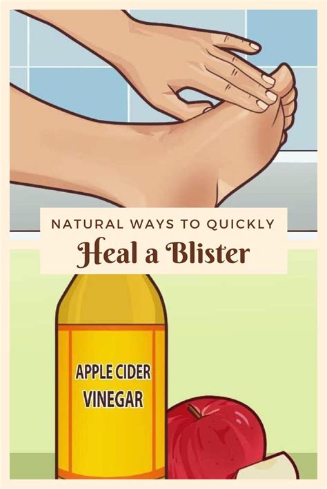 natural ways to quickly heal a blister how to heal blisters blister remedies blister treatment
