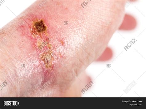 Chemical Burn On Wrist Image And Photo Free Trial Bigstock
