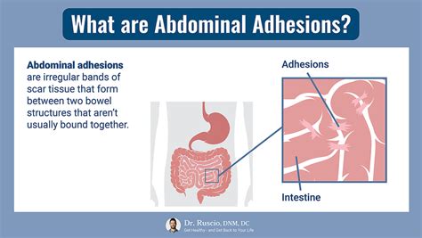 Abdominal Adhesions How To Identify And Treat Them