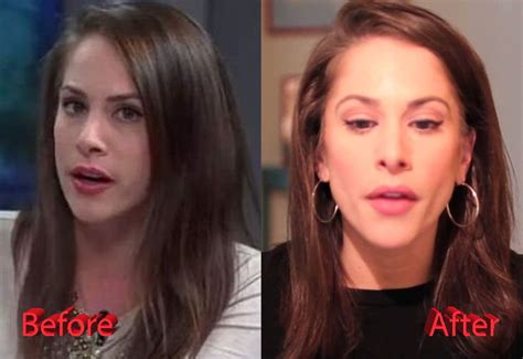ana kasparian nose job before and after
