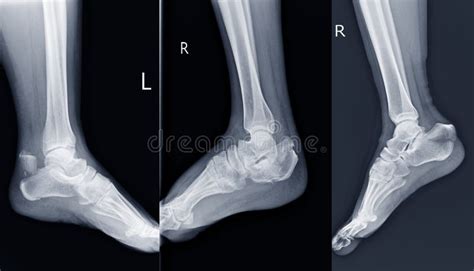 Film Ankle X Ray Radiograph Showing Heel Bone Broken 3 Views Close