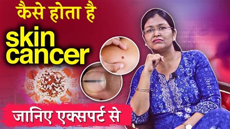 Skin Cancer Symptoms Types And Treatments Youtube
