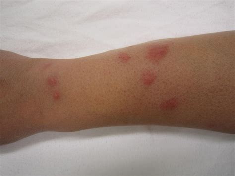 Do Bed Bug Bites Hurt Pain Guide Pestseek