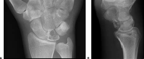 Aneurysmal Bone Cyst Of The Lunate Case Report Journal Of Hand Surgery