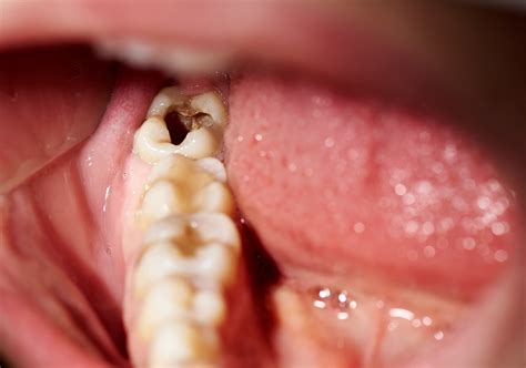 What Are The Signs Of Tooth Decay