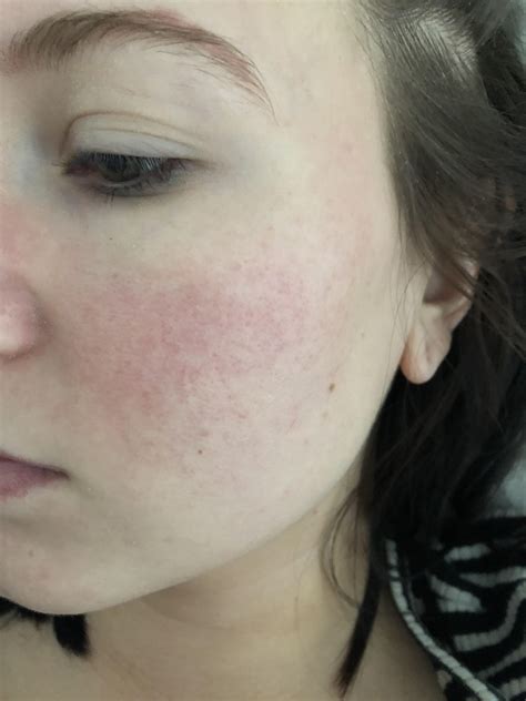Ive Had Skin Redness Around My Cheeks My Whole Life A Dermatologist Years Ago Said Maybe