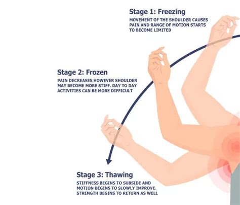 Stages Of Frozen Shoulder My Xxx Hot Girl