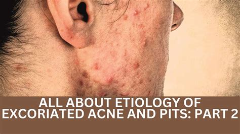 All About Etiology Of Excoriated Acne And Pits Part 2