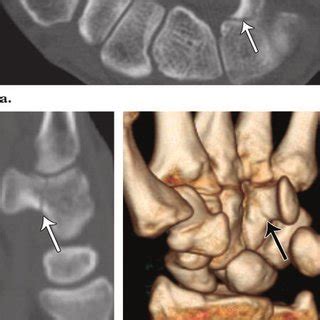 Normal anatomy of the carpal bones. Diagram of the wrist ...